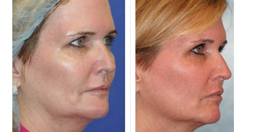 laser skin resurfacing_ba_6.jpg