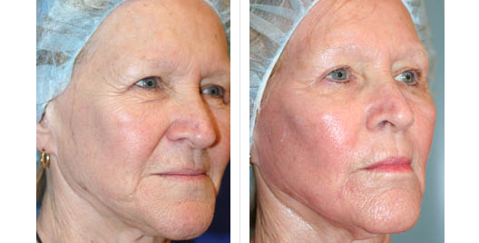 laser skin resurfacing_ba_7.jpg