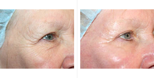 laser skin resurfacing_ba_8.jpg