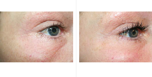 laser skin resurfacing_ba_9.jpg