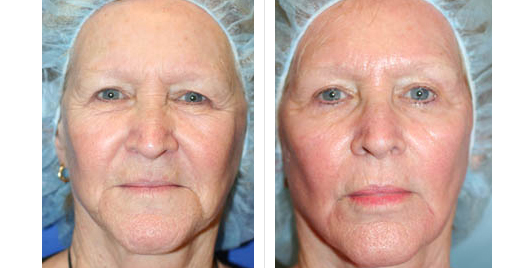 laser skin resurfacing_ba_10.jpg