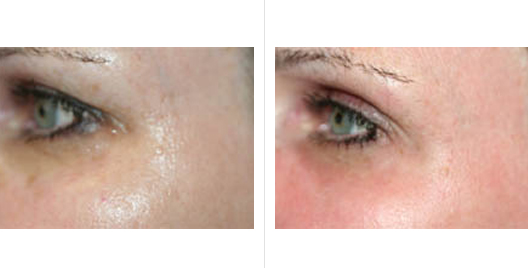 laser skin resurfacing_ba_11.jpg