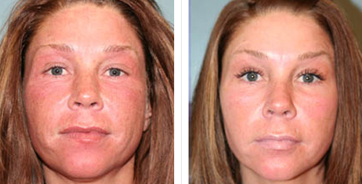 laser skin resurfacing_ba_12.jpg