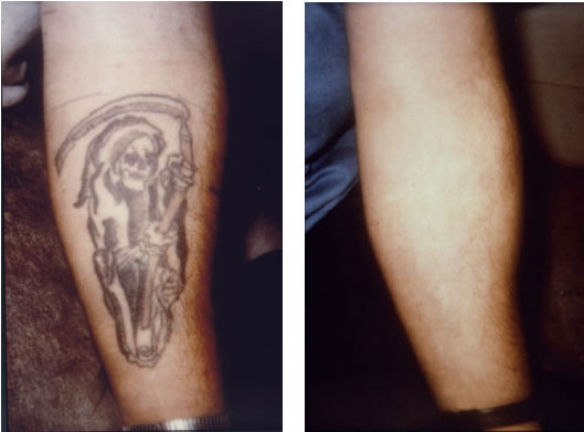 Tattoo removal san francisco