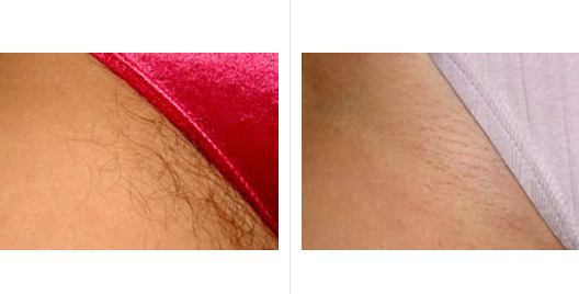 Brazilian Laser Hair Removal Safe And Effective  Dr Nazarian