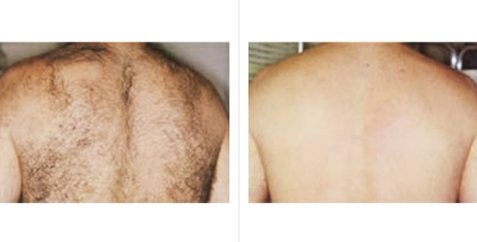 Laser Hair Removal Before and After Photos | Usha Rajagopal, MD