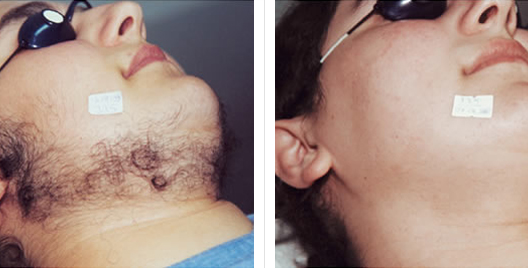 Laser Hair Removal Before and After Photos | Usha Rajagopal, MD