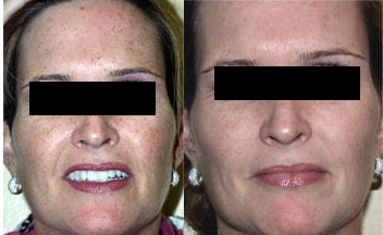 photofacial copy.jpg