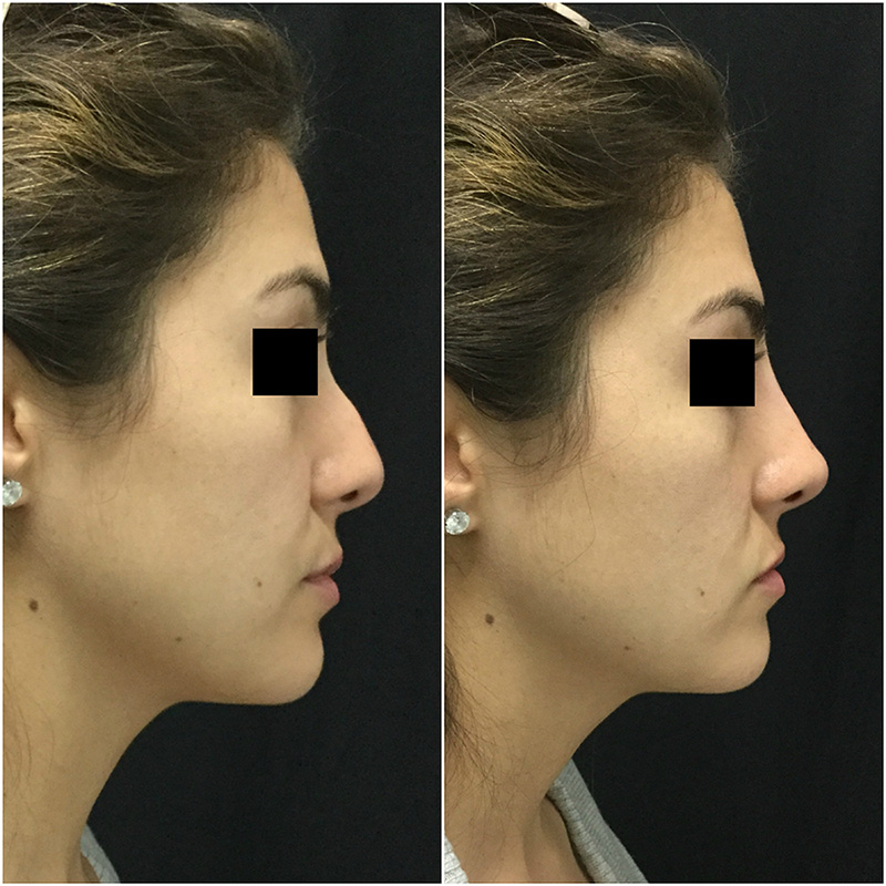 how much is a non surgical nose job in california