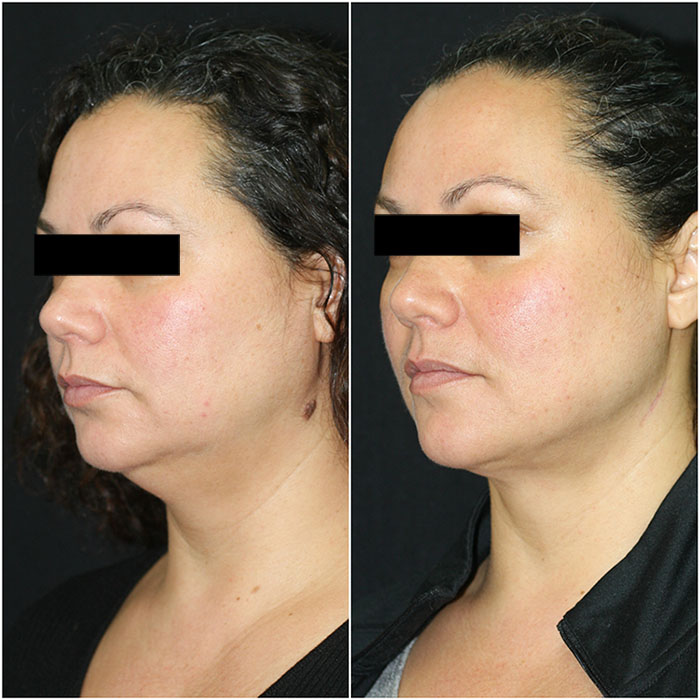 Chin Liposuction Before and After (3 Months Post-Op)