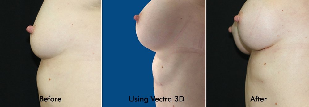Copy of Side Breast Augmentation Before and After