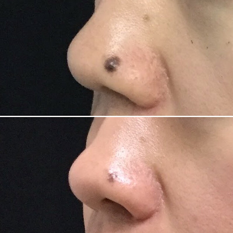 Mole Shaving Before and After