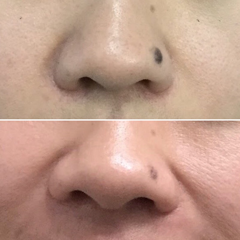 Mole Shaving Before and After