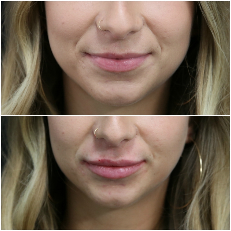 Lip Augmentation Injections Before and After.