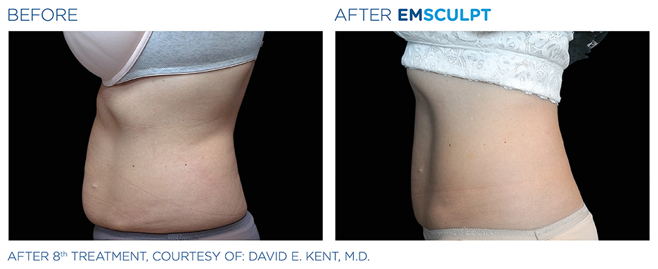 Emsculpt Before and After Photo San Francisco