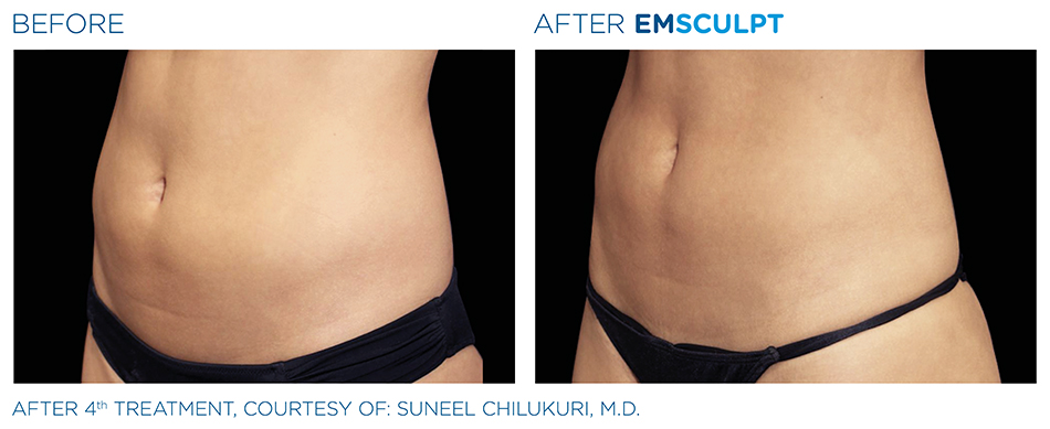 Emsculpt_PIC_Ba-card-female-abdomen-011_ENUS100.jpg