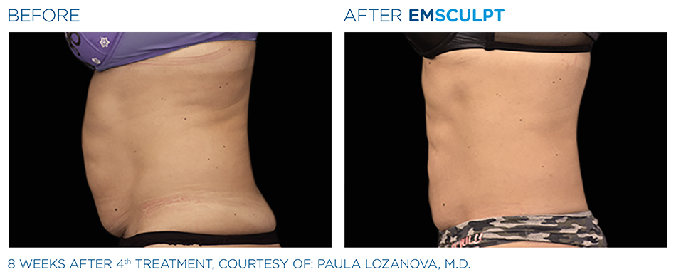 Emsculpt_PIC_Ba-card-female-abdomen-029_ENUS100.jpg