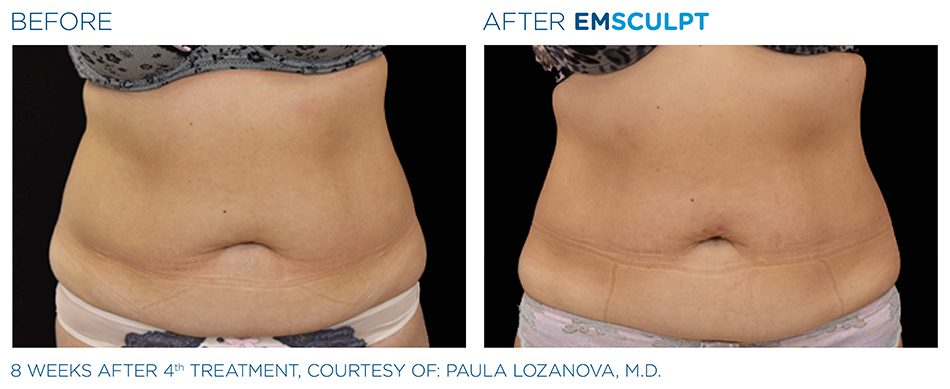 Emsculpt_PIC_Ba-card-female-abdomen-027_ENUS100.jpg