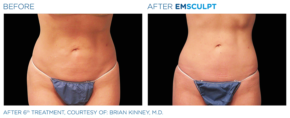 Emsculpt_PIC_Ba-card-female-abdomen-031_ENUS100.jpg