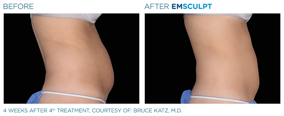 Emsculpt_PIC_Ba-card-female-abdomen-003_ENUS100.jpg