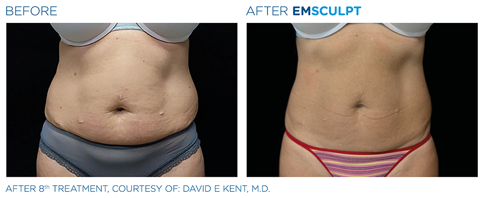 Emsculpt_PIC_Ba-card-female-abdomen-034_ENUS100.png