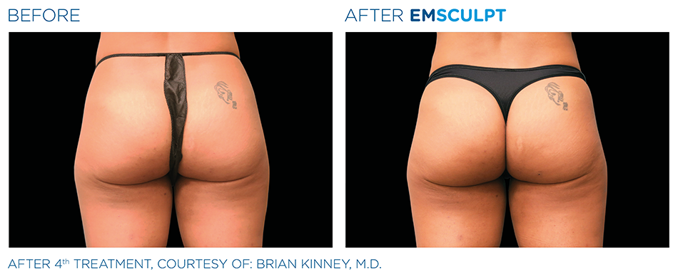 Emsculpt_PIC_Ba-card-female-buttock-014_ENUS100.png