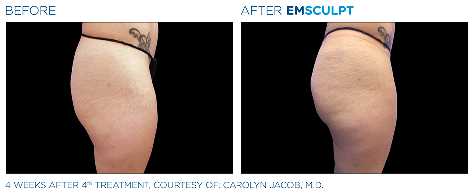 Emsculpt_PIC_Ba-card-female-buttock-017_ENUS100.png