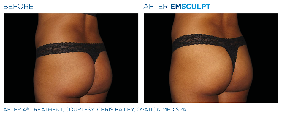 Emsculpt_PIC_Ba-card-female-buttock-036_ENUS100.png