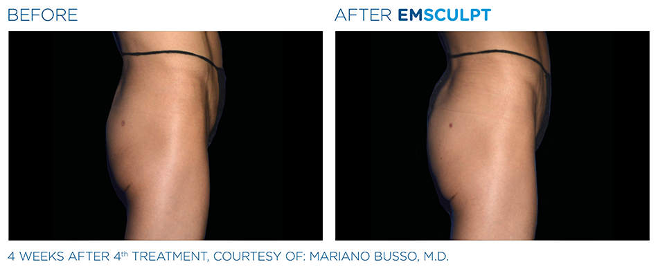 Emsculpt_PIC_Ba-card-female-buttock-040_ENUS100.png