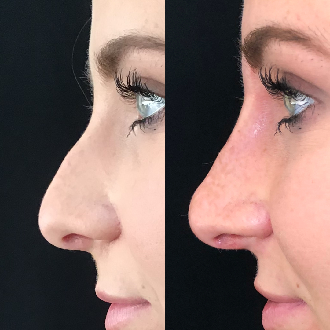 Non Surgical Rhinoplasty Nose Job Before and After.