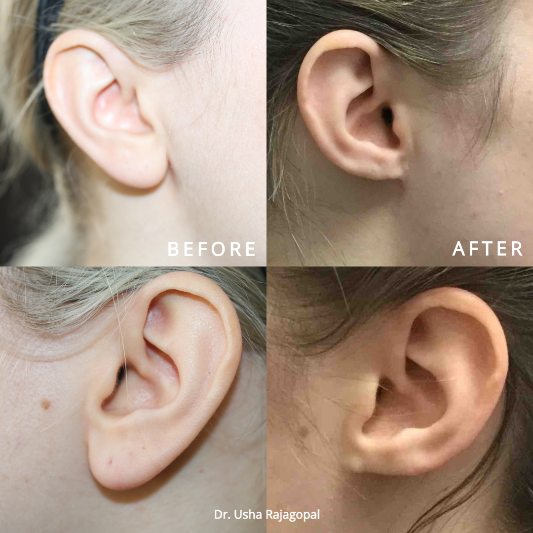 Chao Plastic Surgery - Earlobe filler! It's a perfect, nonsurgical repair  for saggy earlobes. Earrings hanging? Earlobes stretched out? Make an  appointment today! ✨ No downtime. Lasts 1+ years