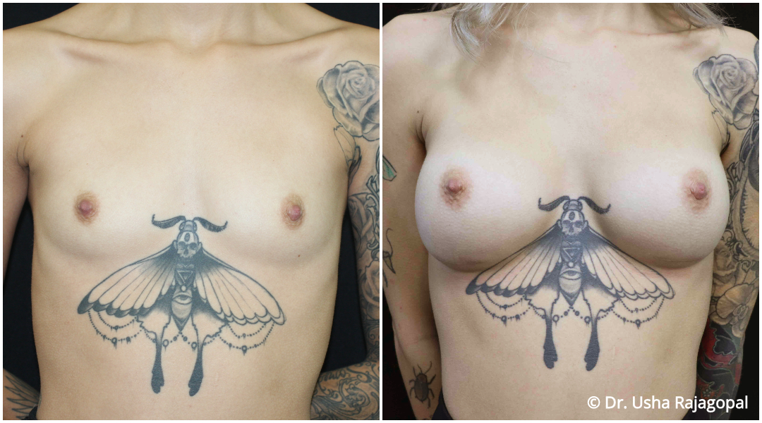 Breast Augmentation Before and After