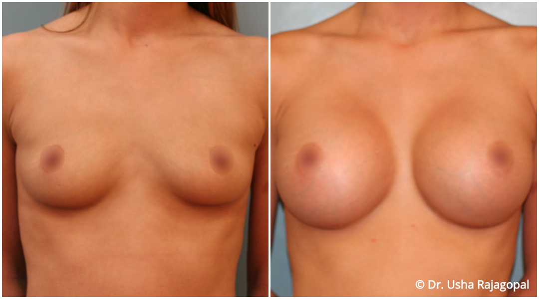 Breast Augmentation Before and After