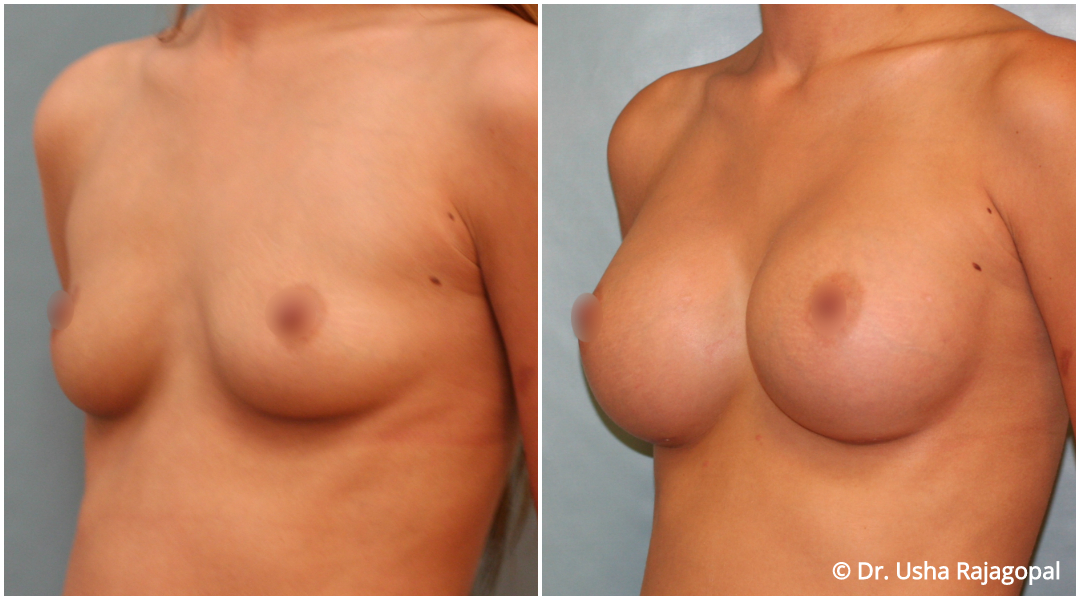 Breast Augmentation Before and After