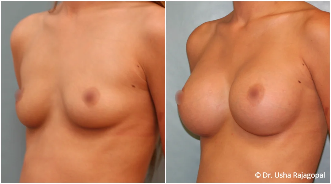 breast-aug-web-11.jpg