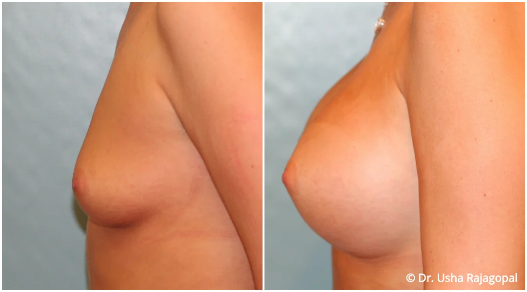 breast-aug-web-12.jpg