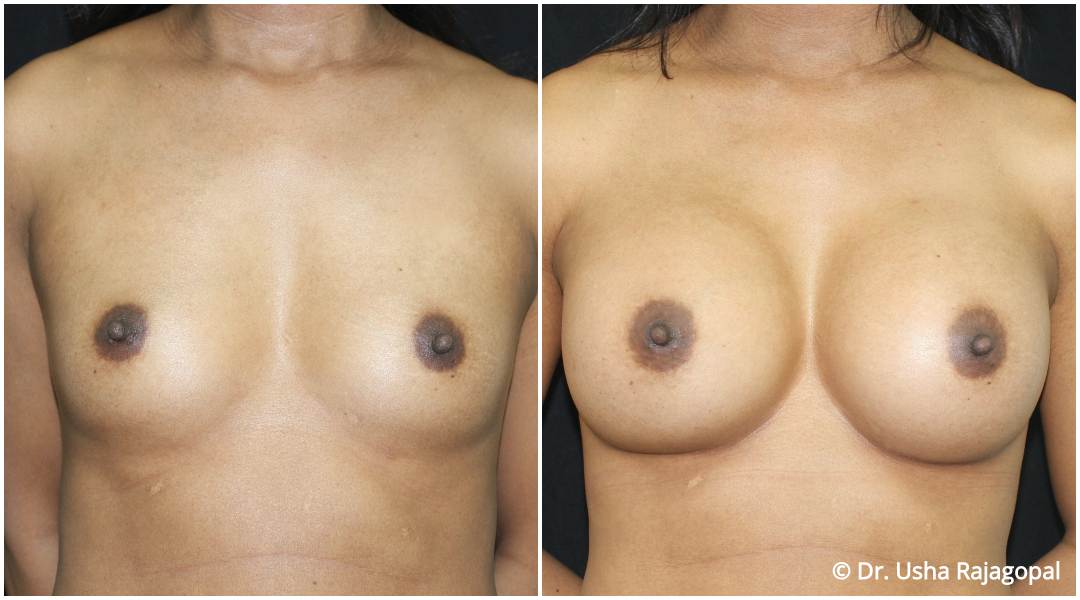 Breast Augmentation Before and After