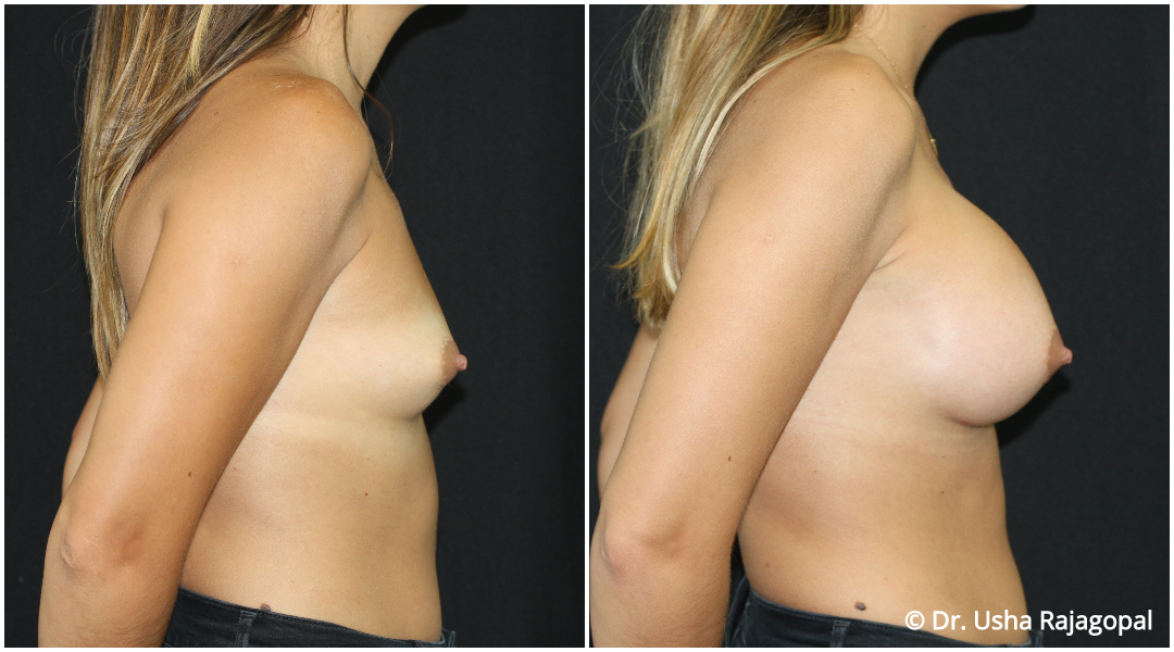 Breast Augmentation Before and After