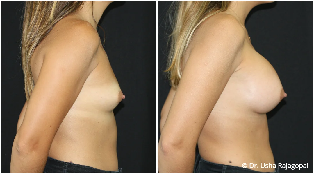 breast-aug-web-17.jpg