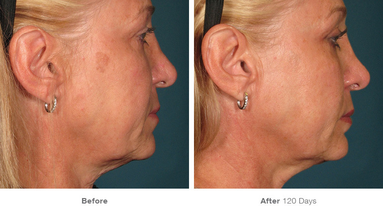 before_after_ultherapy_results_full-face5.jpg