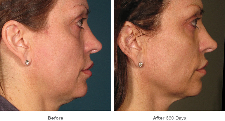 before_after_ultherapy_results_full-face3.jpg