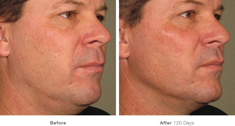 before_after_ultherapy_results_full-face11.jpg