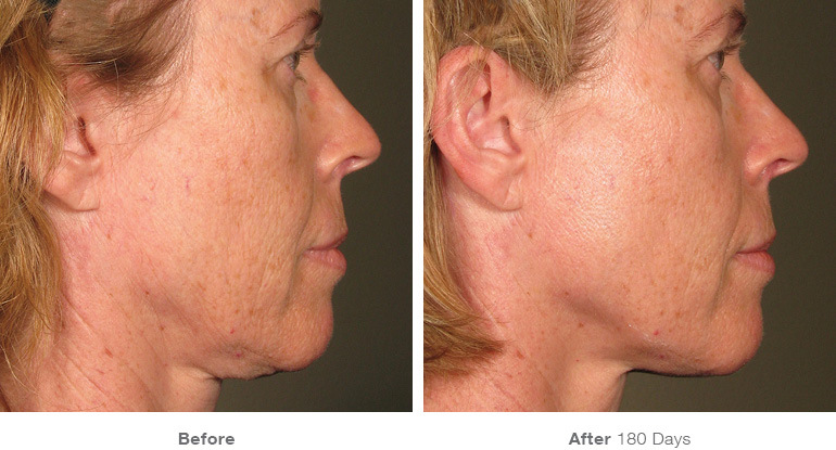 before_after_ultherapy_results_full-face15.jpg