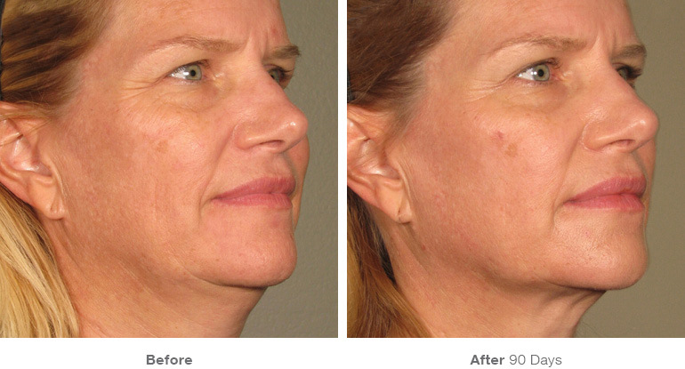 before_after_ultherapy_results_full-face21.jpg