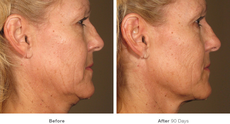 before_after_ultherapy_results_full-face24.jpg