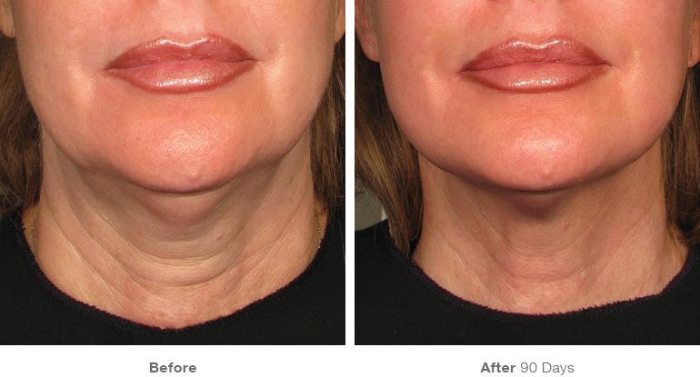 before_after_ultherapy_results_neck3.jpg