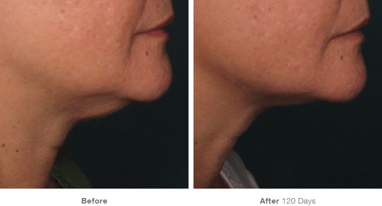 before_after_ultherapy_results_under-chin1.jpg