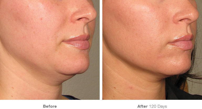 before_after_ultherapy_results_under-chin18.jpg
