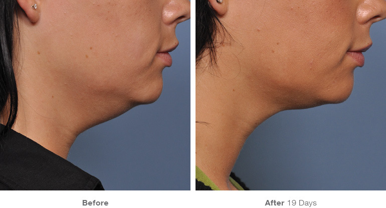 before_after_ultherapy_results_under-chin38.jpg