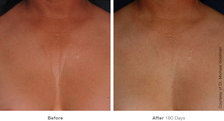 ultherapy-0007-0093ah_180day_1tx_chest_gallery.jpg